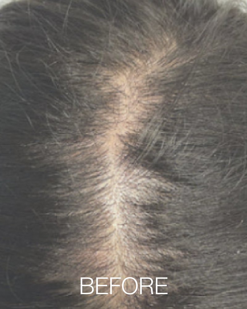 Three (3) Treatments of HydraScalp - Partial Scalp + Get FREE HydraFacial Keravive Peptide Complex Spray ($95 Value)