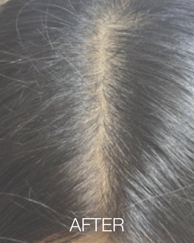 Three (3) Treatments of HydraScalp - Partial Scalp + Get FREE HydraFacial Keravive Peptide Complex Spray ($95 Value)