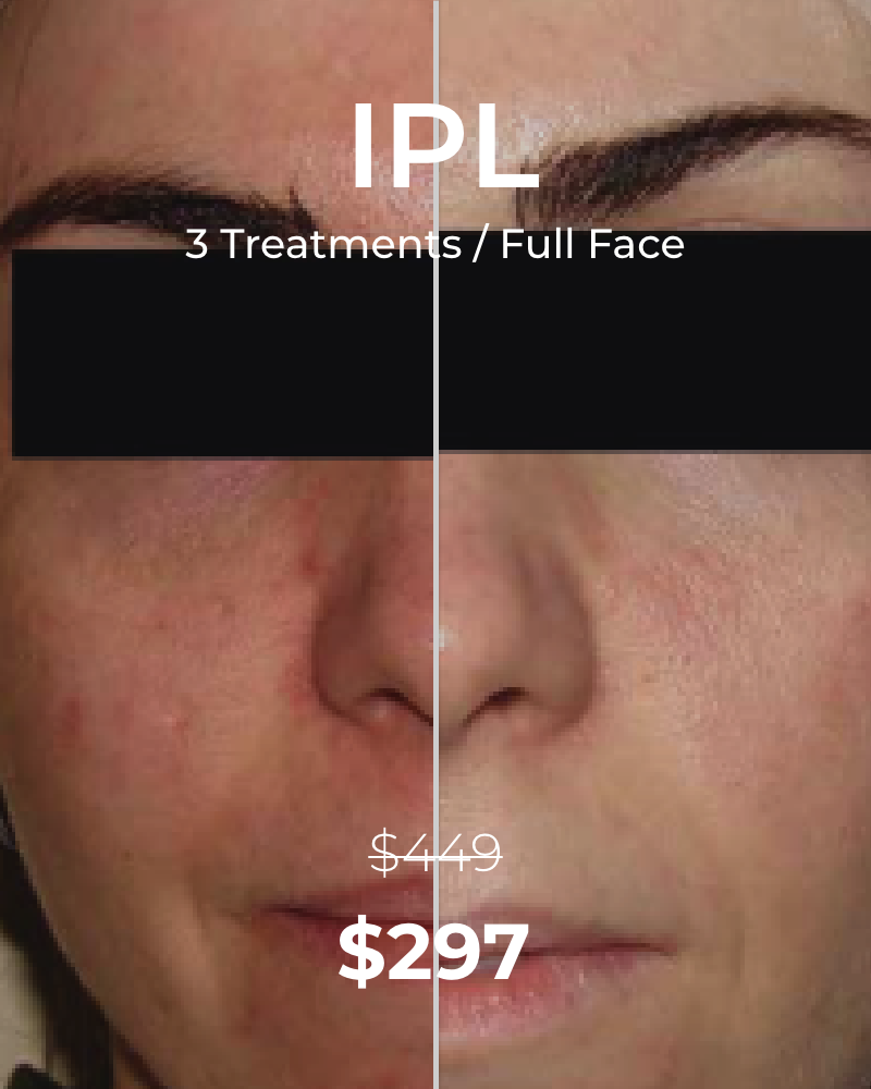 Three (3) IPL Photofacial (Full Face) Treatments