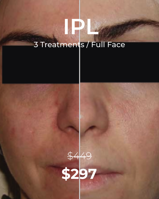 Three (3) IPL Photofacial (Full Face) Treatments