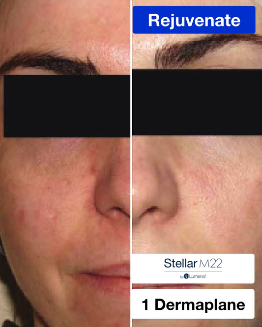 One (1) IPL Photofacial + Dermaplane Treatment
