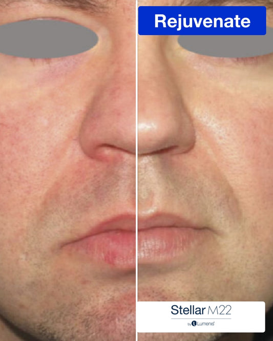 IPL Photofacial (Full Face) - One (1) or Three (3) Treatments