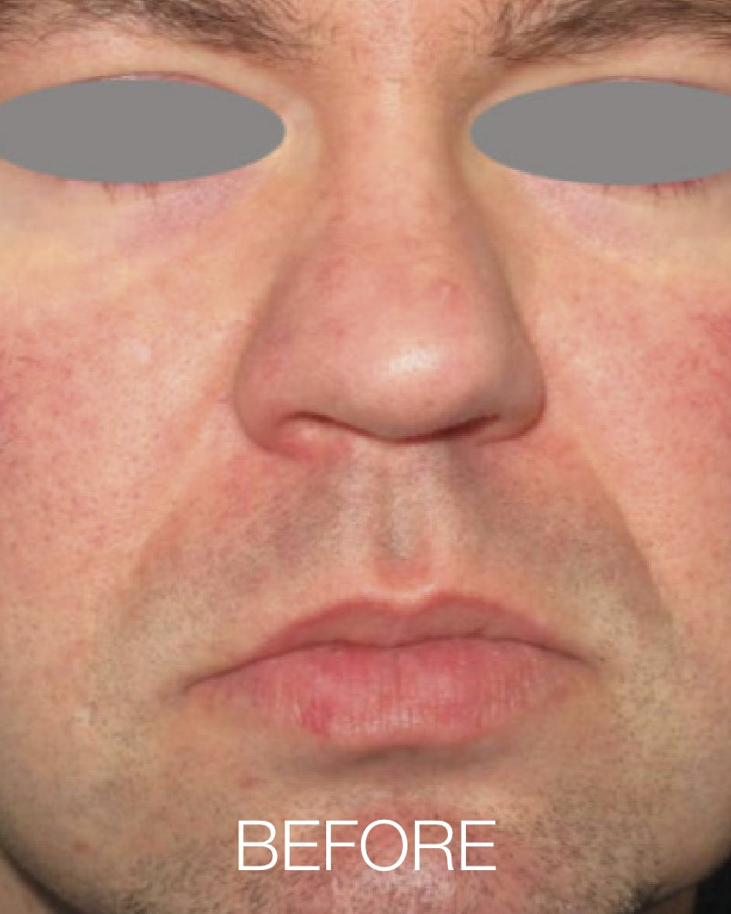 IPL Photofacial (Full Face) - One (1) or Three (3) Treatments