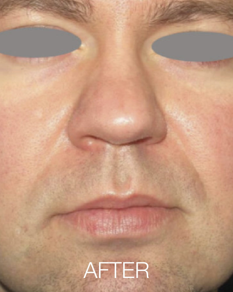 IPL Photofacial (Full Face) - One (1) or Three (3) Treatments