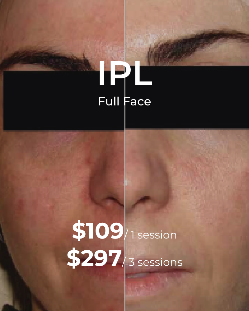 IPL Photofacial – Full Face, One (1) or Three (3) Sessions