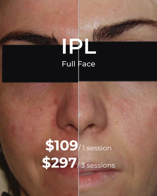 IPL Photofacial – Full Face, One (1) or Three (3) Sessions