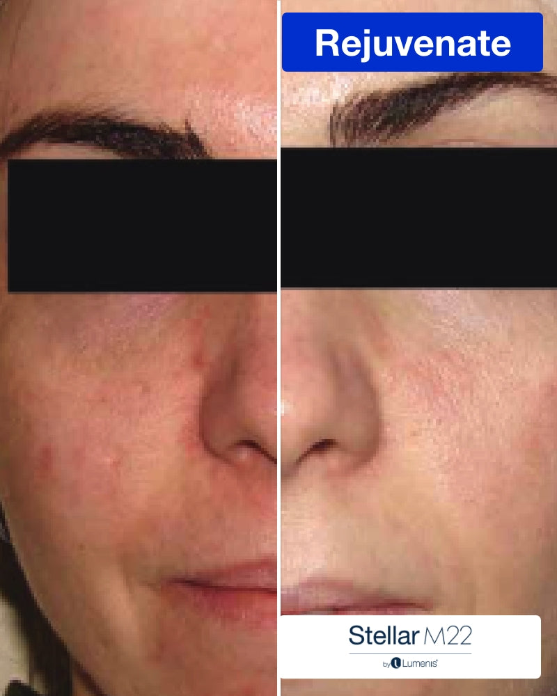 Service Voucher - One (1)  IPL Photofacial (Full Face) $119