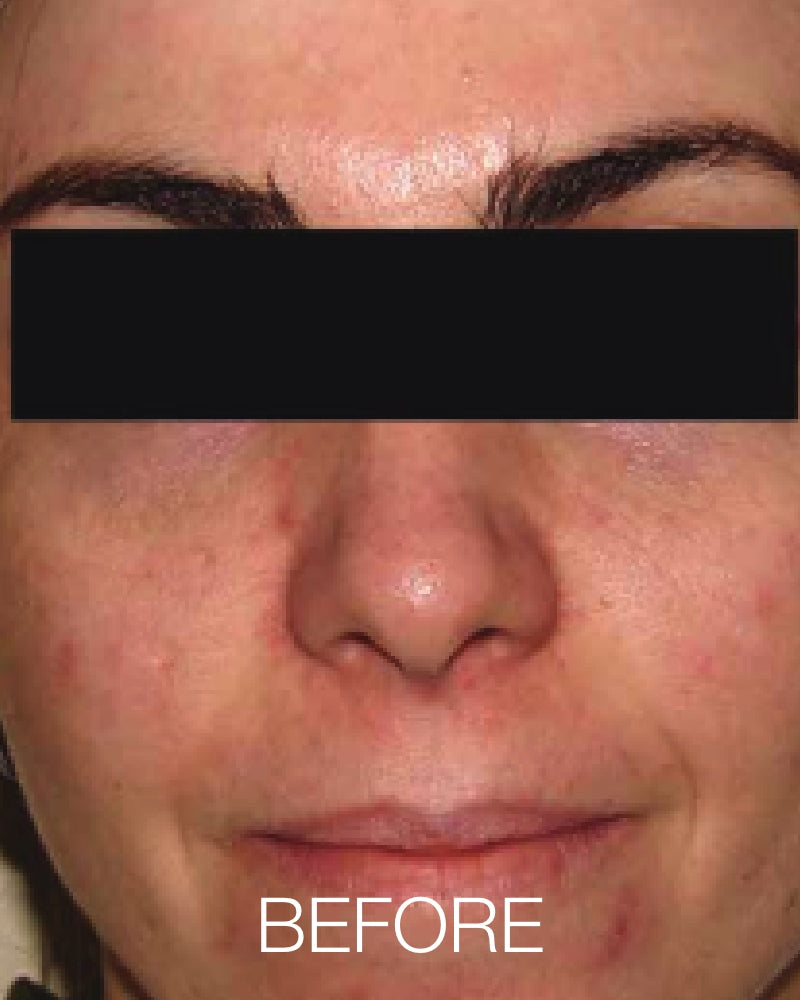 Service Voucher - One (1)  IPL Photofacial (Full Face) $119