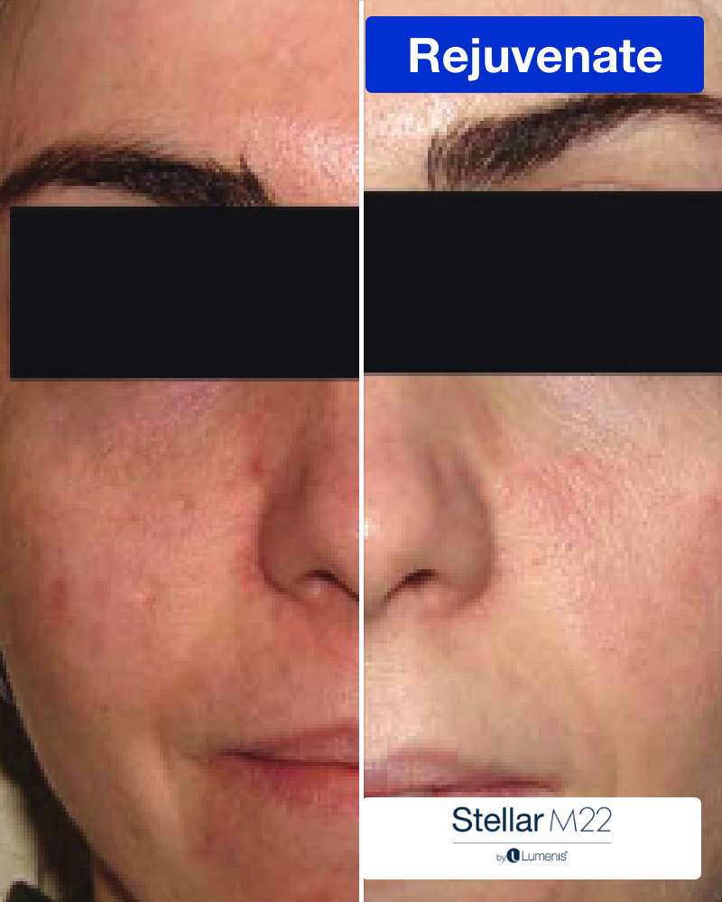 Three (3) IPL Photofacial (Full Face) Treatments