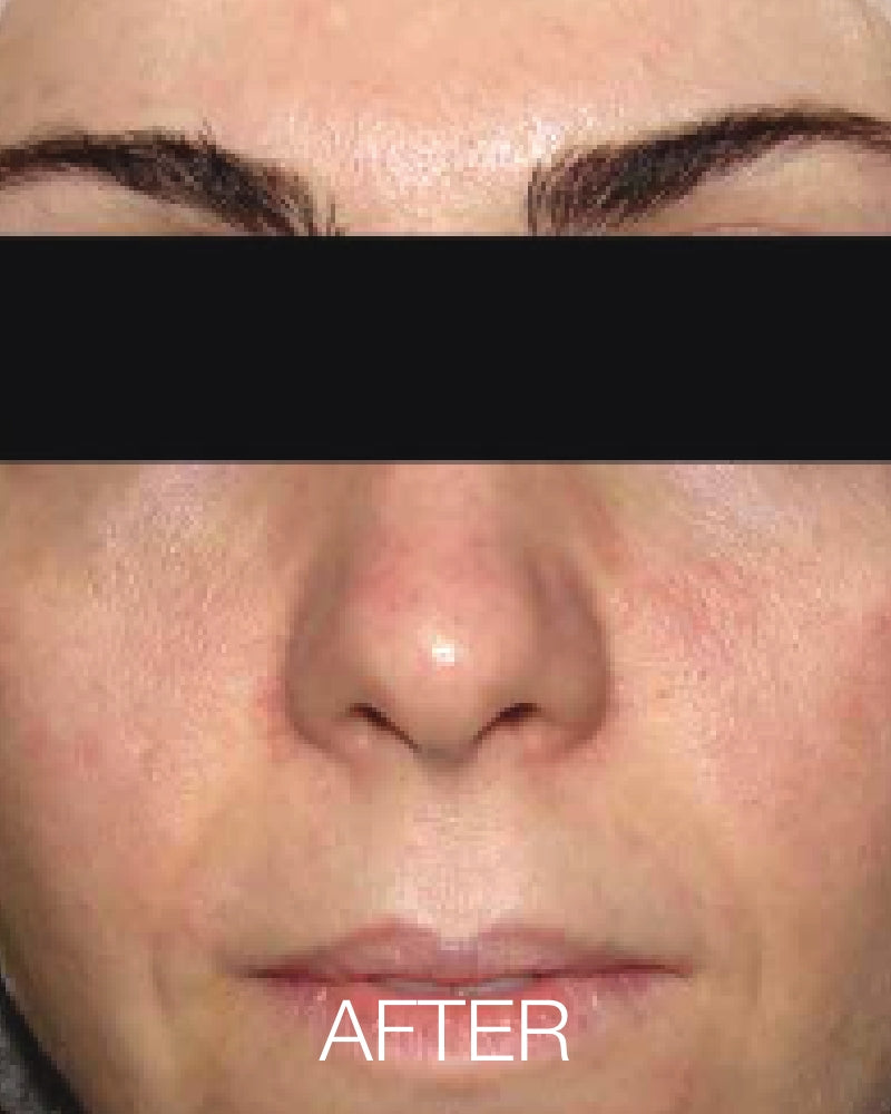 Service Voucher - One (1)  IPL Photofacial (Full Face) $119