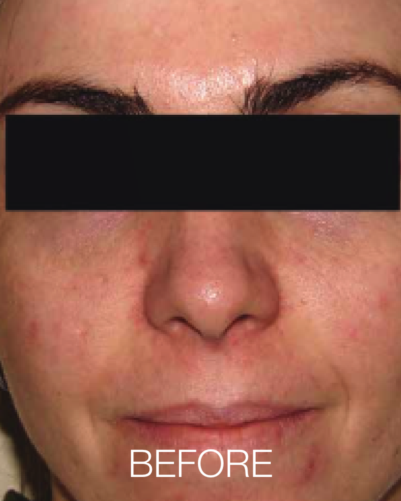 Three (3) IPL Photofacial (Full Face) Treatments