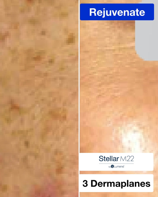 Three (3) IPL Photofacial + Dermaplane Treatments