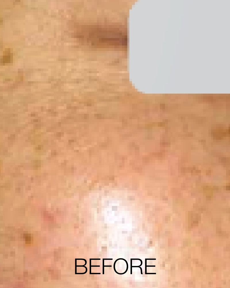 Three (3) IPL Photofacial + Dermaplane Treatments