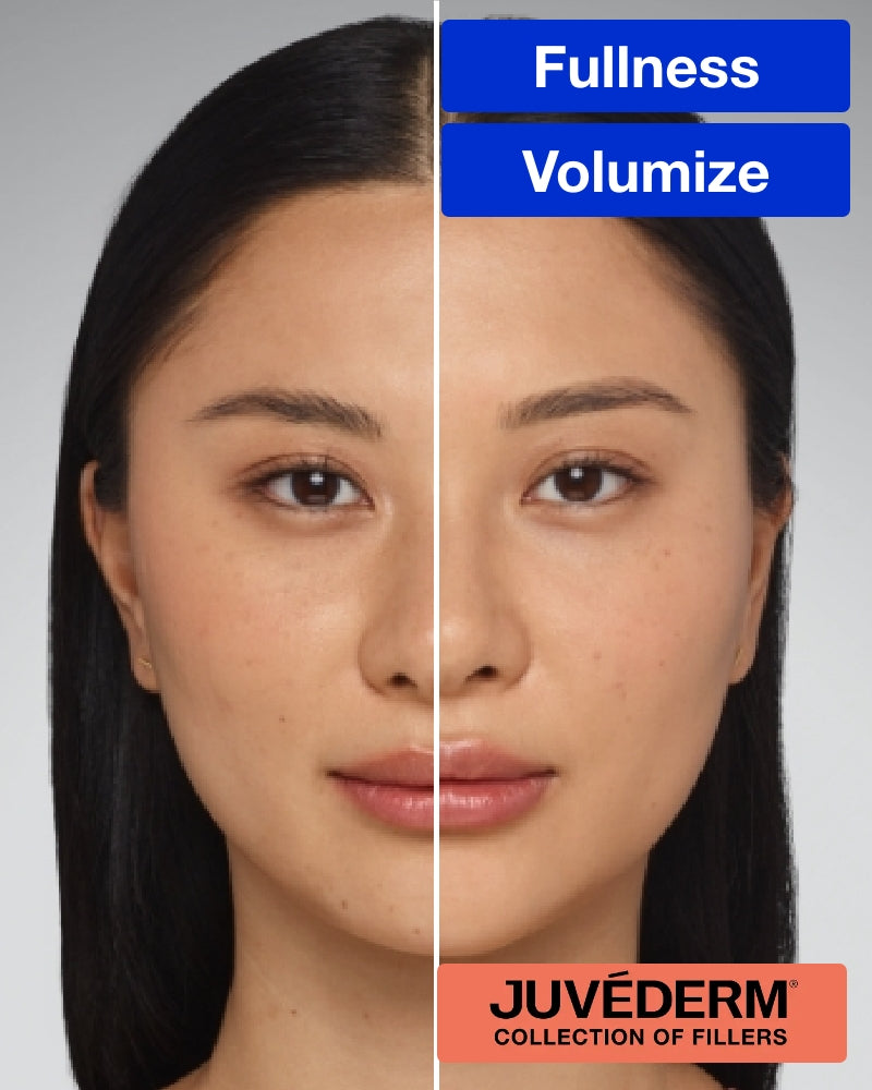 Service Voucher - Juvederm Ultra XC - 1ml Syringe