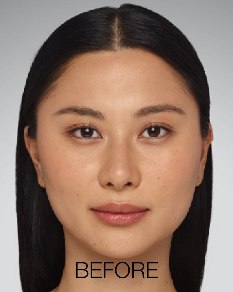 Service Voucher - Juvederm Ultra XC - 1ml Syringe