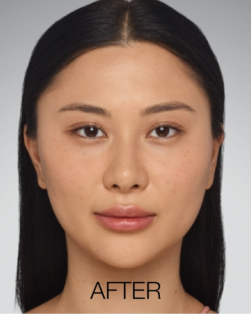 Service Voucher - Juvederm Ultra XC - 1ml Syringe