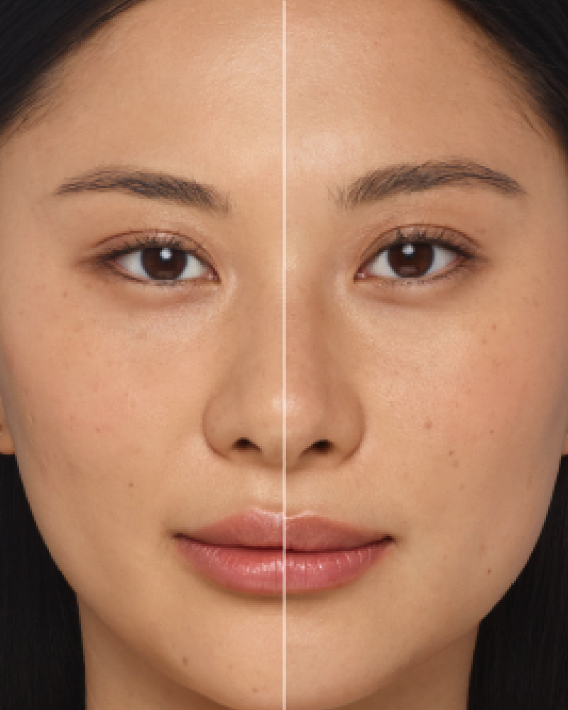 Service Voucher - Juvederm Ultra XC - 1ml Syringe