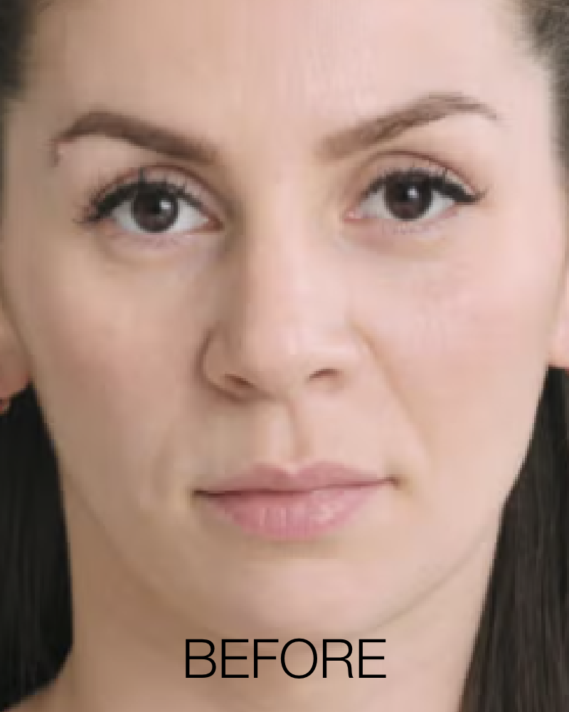 Service Voucher - Kiss Me Package: Lip Filler (Restylane Kysse) with FREE Lip Flip