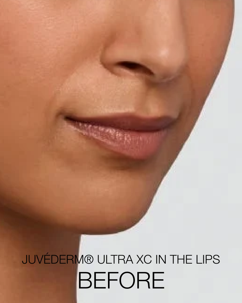 Service Voucher - Great Looking Lips Package: 1 Syringe of Juvederm Ultra XC + One (1) Signature HydraFacial (Full Face)