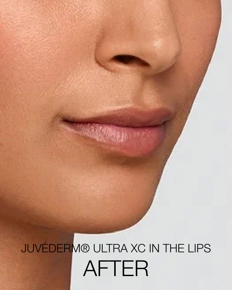 Service Voucher - Great Looking Lips Package: 1 Syringe of Juvederm Ultra XC + One (1) Signature HydraFacial (Full Face)