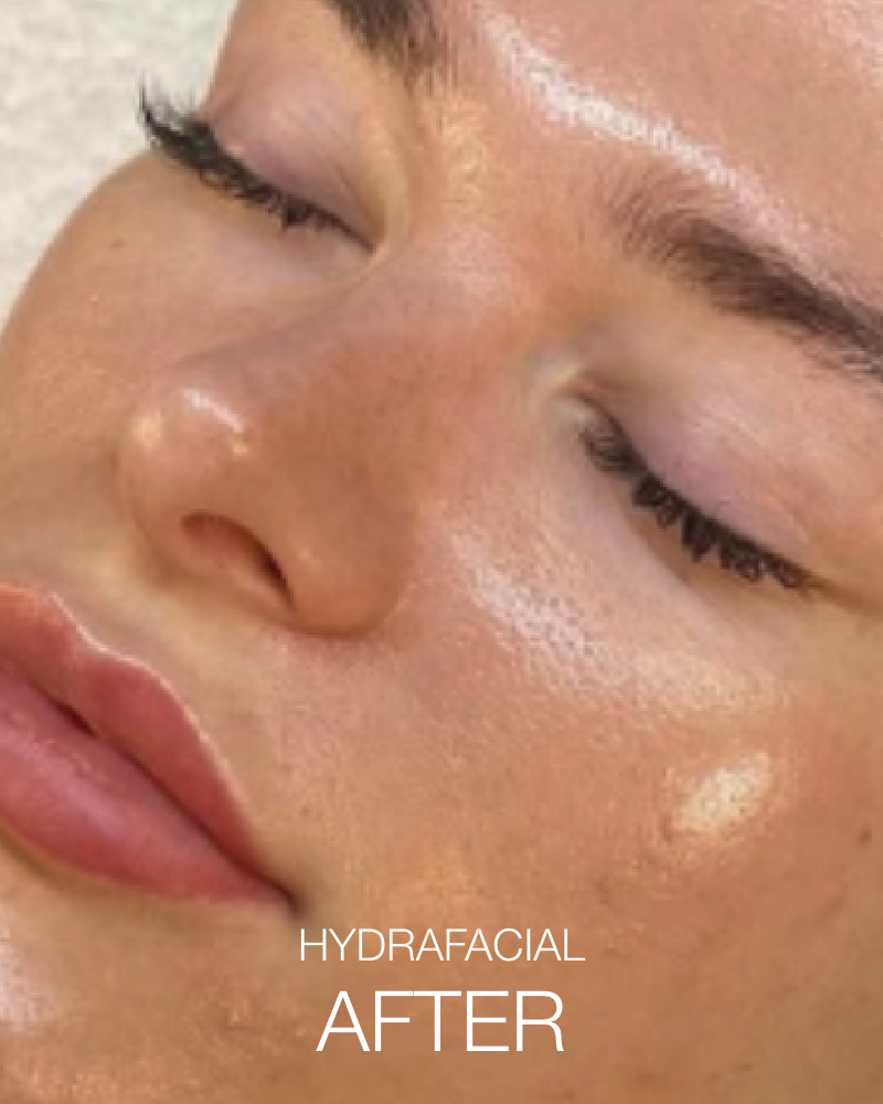 One (1) Signature HydraFacial - Full Face & Neck