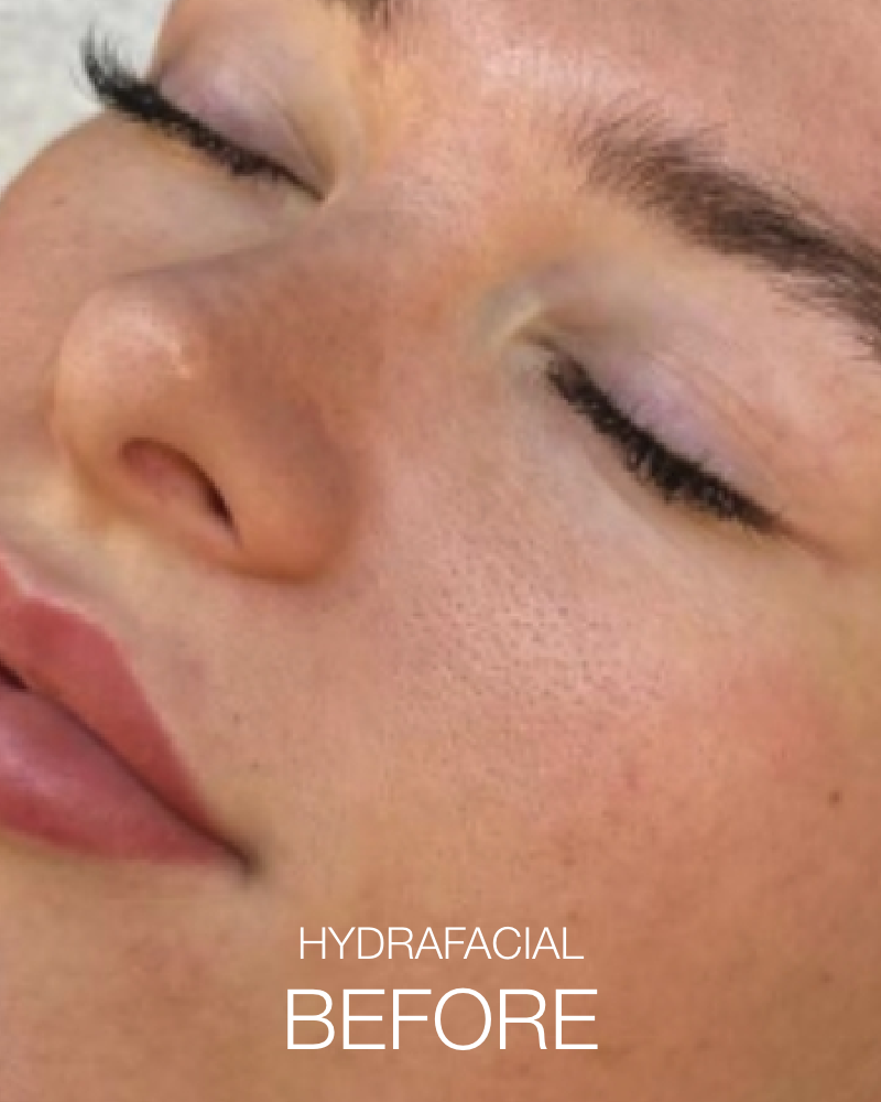 Service Voucher - Great Looking Lips Package: 1 Syringe of Juvederm Ultra XC + One (1) Signature HydraFacial (Full Face)