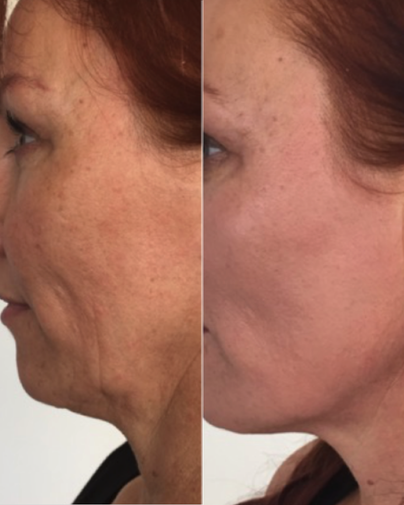 25% OFF PDO Threads with $100 Deposit