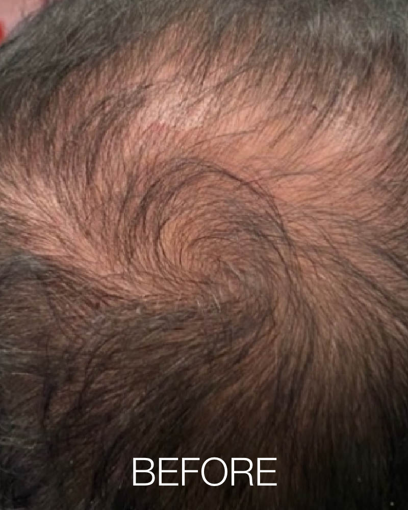 Service Voucher - Three (3) PRP Hair Restoration Treatments