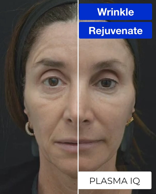 One (1) Plasma IQ Treatment for Crow’s Feet or Brow Lift