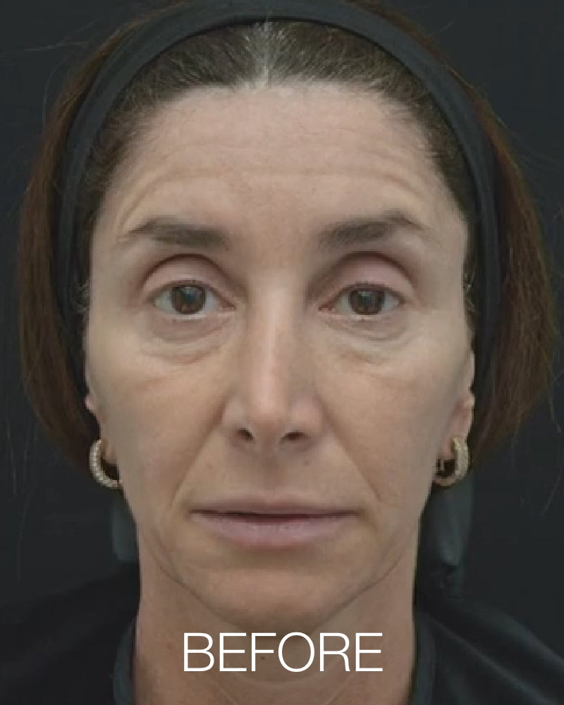 One (1) Plasma IQ Treatment for Marionette Lines, Upper Eyes or Under Eyes