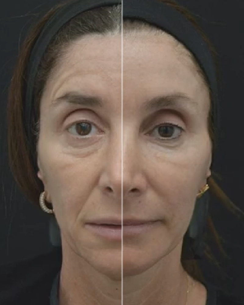 One (1) Plasma IQ Pen Treatment - Brow Lift
