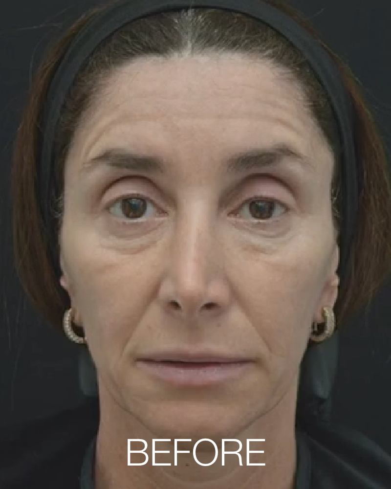 One (1) Plasma IQ Pen Treatment - Brow Lift