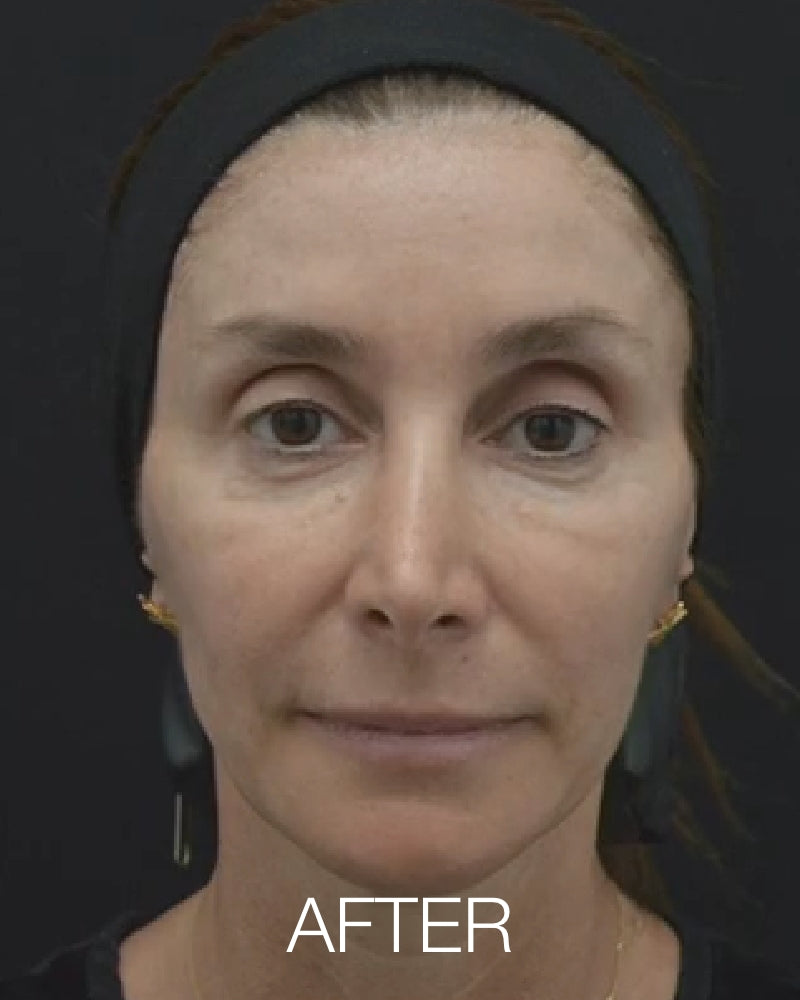 One (1) Plasma IQ Treatment for Marionette Lines, Upper Eyes or Under Eyes