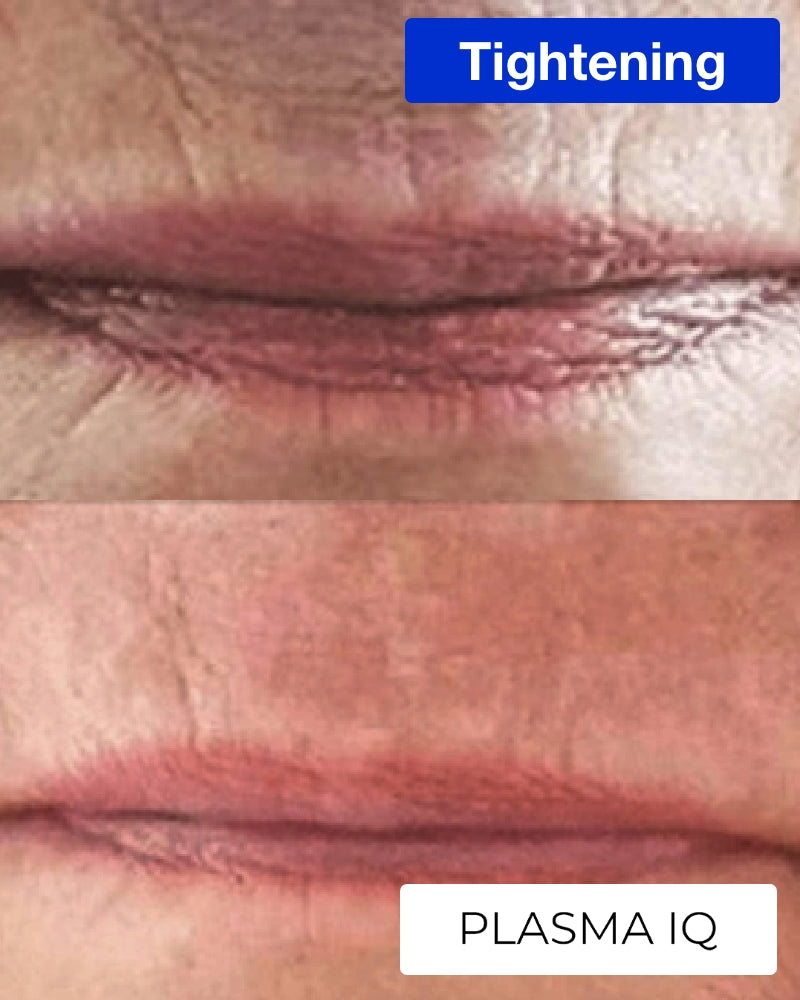 Service Voucher - Plasma IQ / Upper Lip