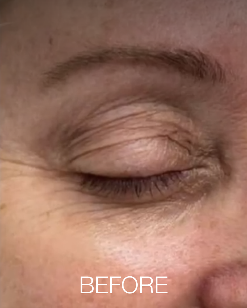One (1) Plasma IQ Pen Treatment - Crow’s Feet