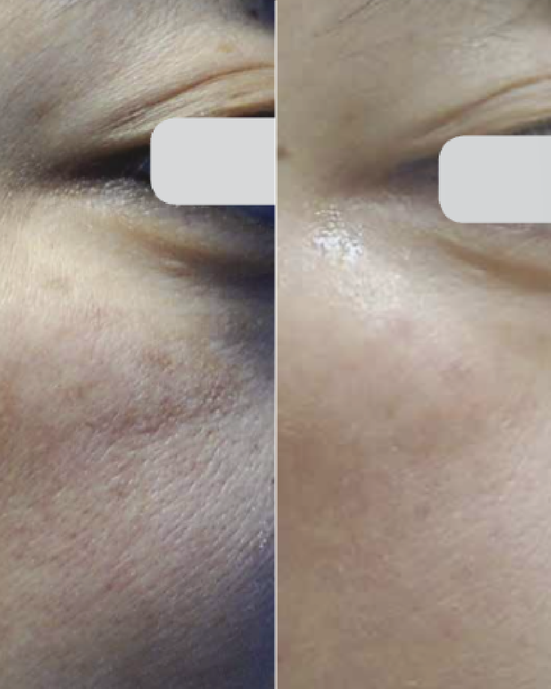 One (1) Q-Switch Laser Facial Full Face Treatment