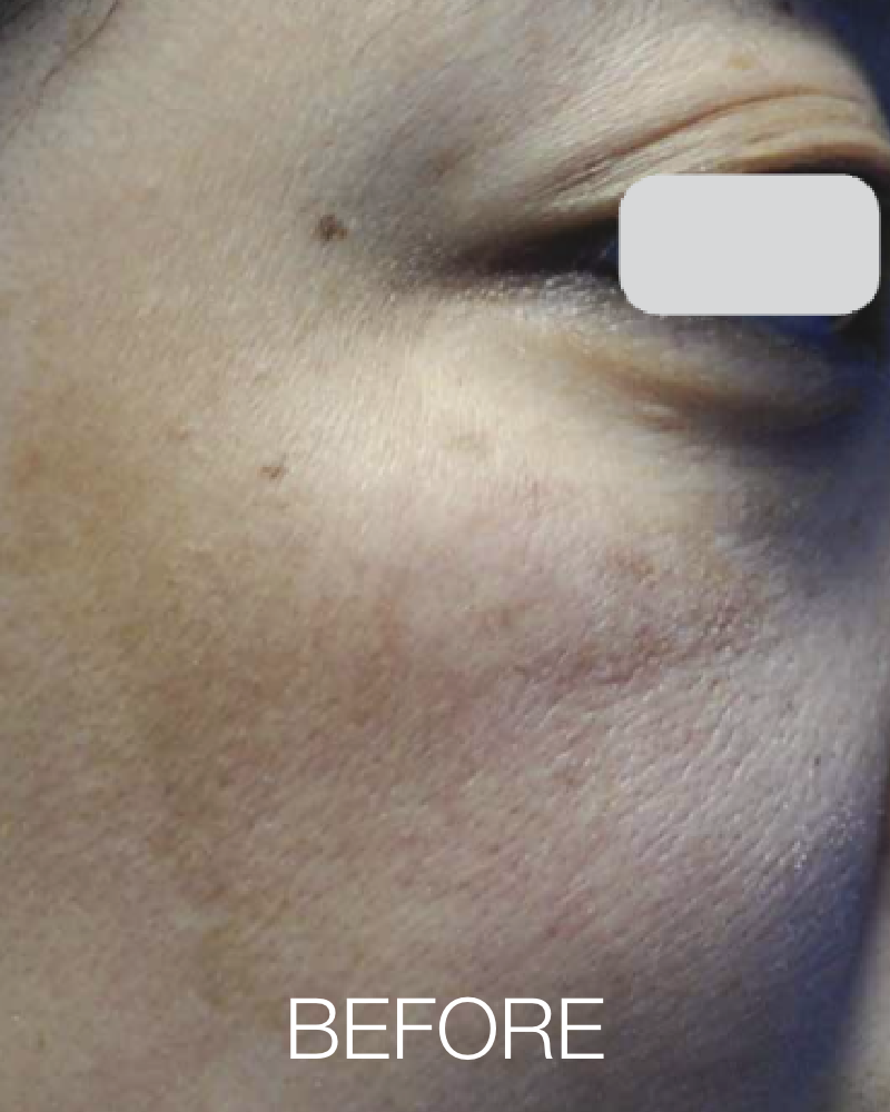 One (1) Q-Switch Laser Facial Full Face Treatment