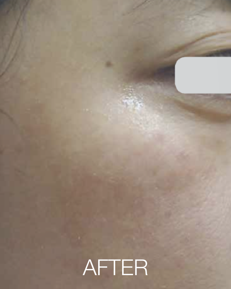 One (1) Q-Switch Laser Facial Full Face Treatment