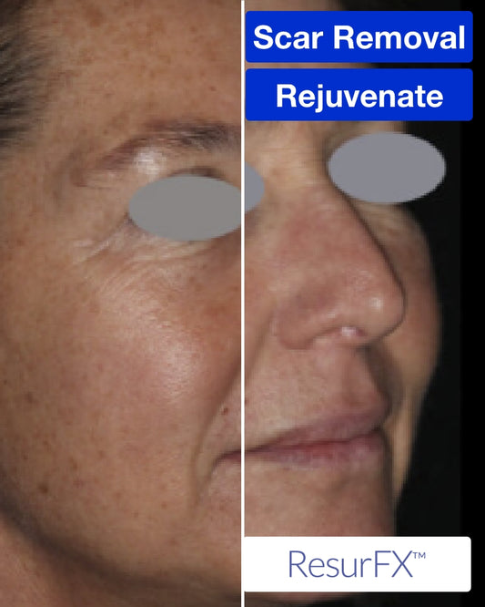 Three (3) ResurFX Treatments (Full Face) + FREE Hydrinity Restorative Mask & Post Procedure Kit ($156 Value)