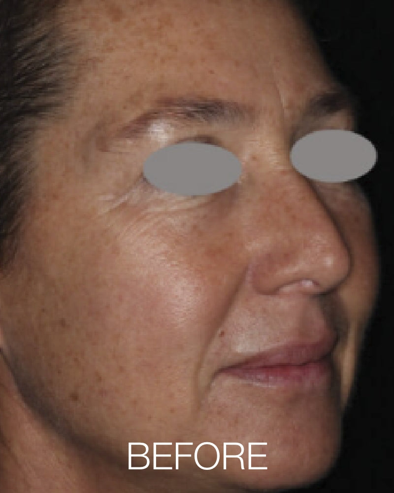 Three (3) ResurFX Treatments (Full Face) + FREE Hydrinity Restorative Mask & Post Procedure Kit ($156 Value)