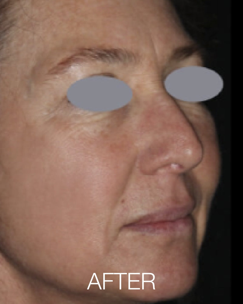 Three (3) ResurFX Treatments (Full Face) + FREE Hydrinity Restorative Mask & Post Procedure Kit ($156 Value)