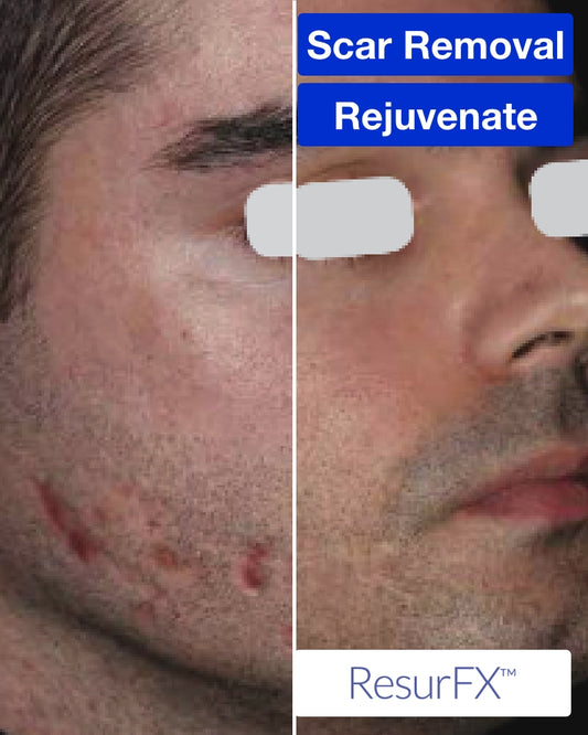 Six (6) ResurFX Treatments (Full Face) + FREE Hydrinity Restorative Mask & Post Procedure Kit ($156 Value)