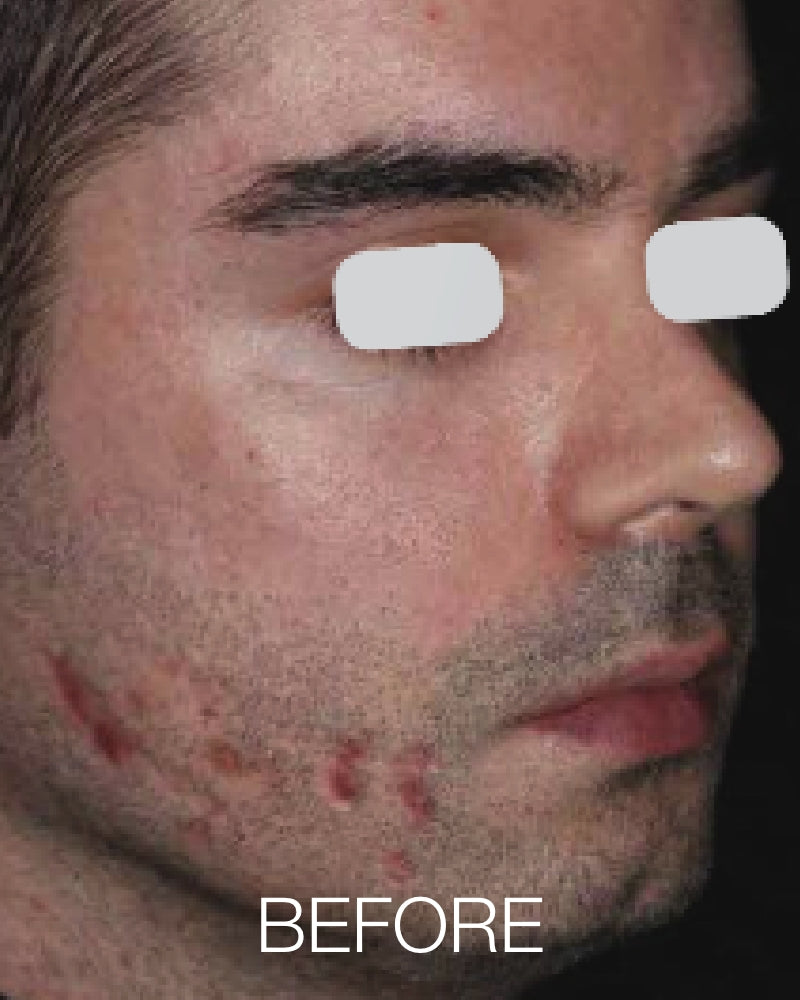 Six (6) ResurFX Treatments (Full Face) + FREE Hydrinity Restorative Mask & Post Procedure Kit ($156 Value)