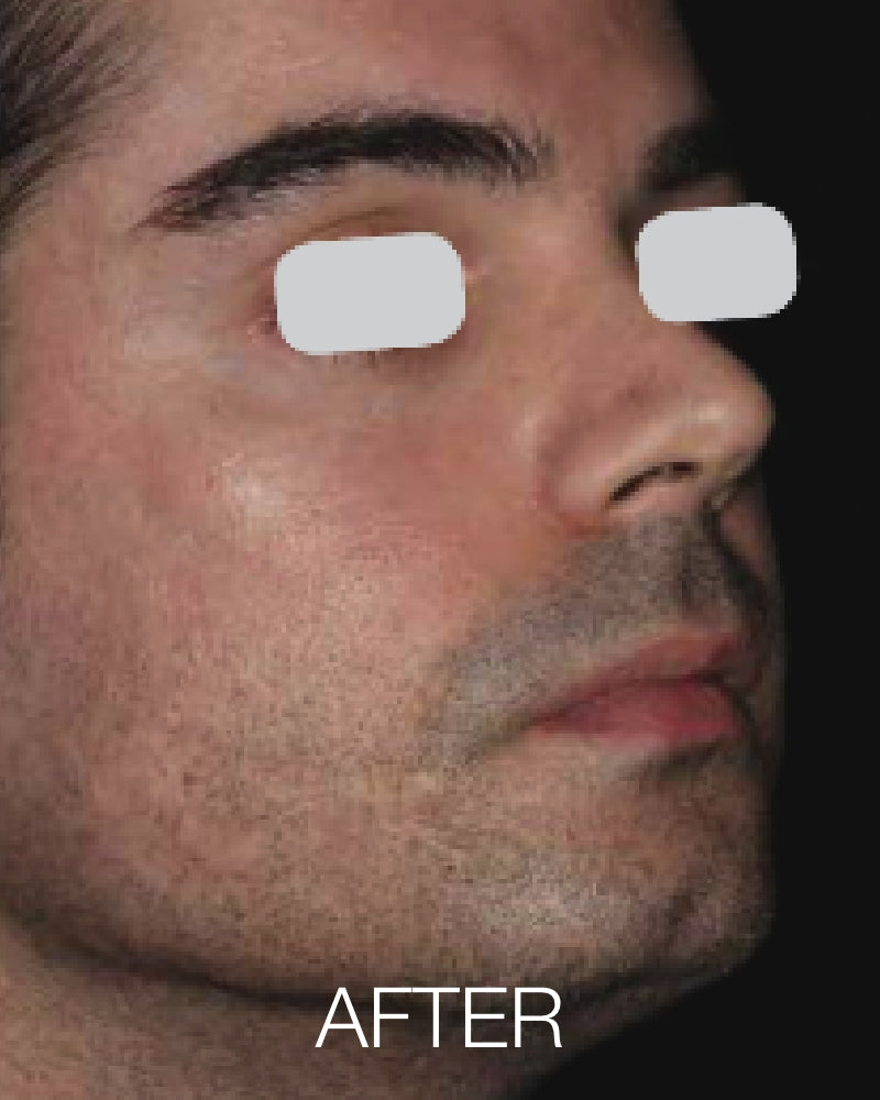 Six (6) ResurFX Treatments (Full Face) + FREE Hydrinity Restorative Mask & Post Procedure Kit ($156 Value)