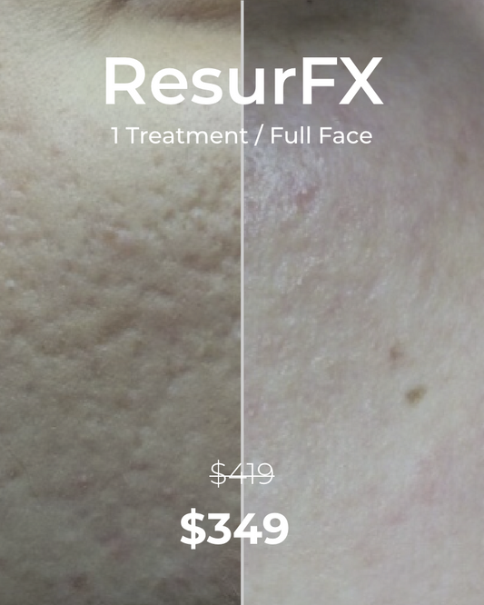 One (1) ResurFX Treatments (Full Face)