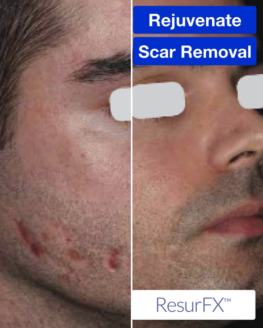 Service Voucher - Three (3) ResurFX Treatments (Full Face)