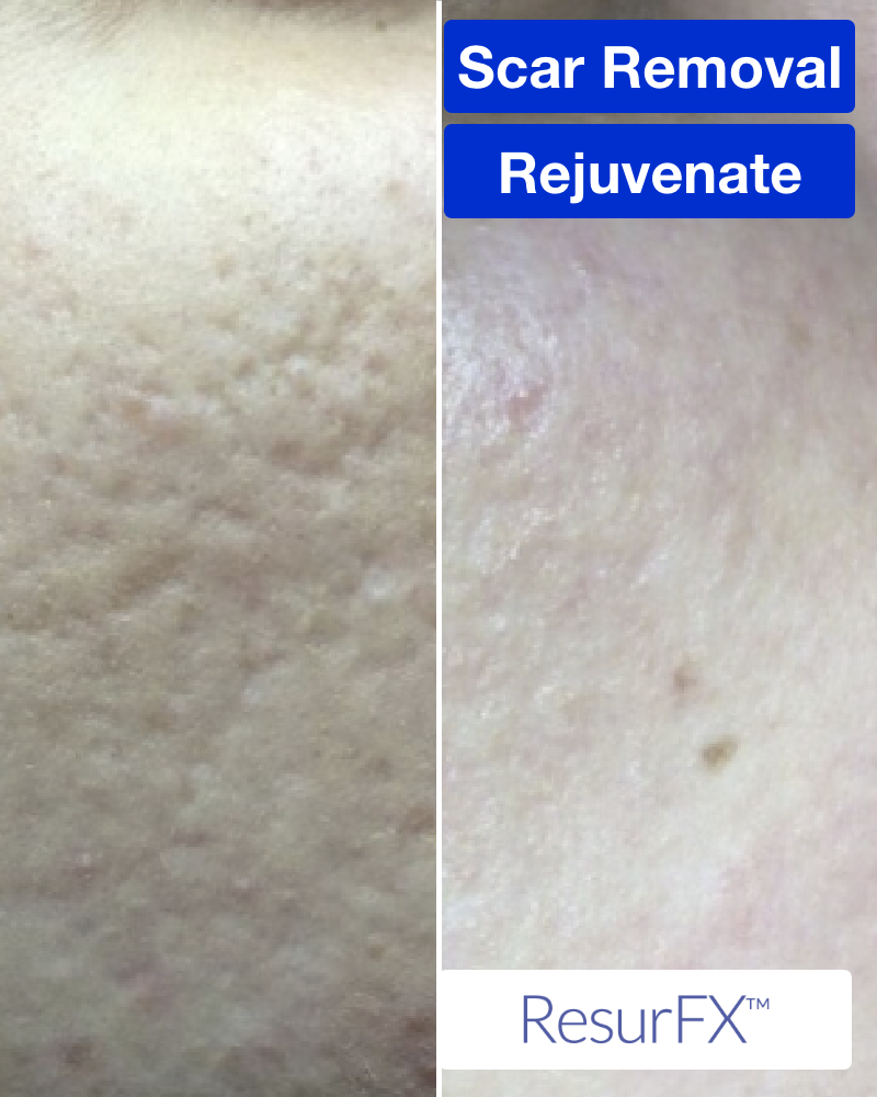 One (1) ResurFX Treatments (Full Face)