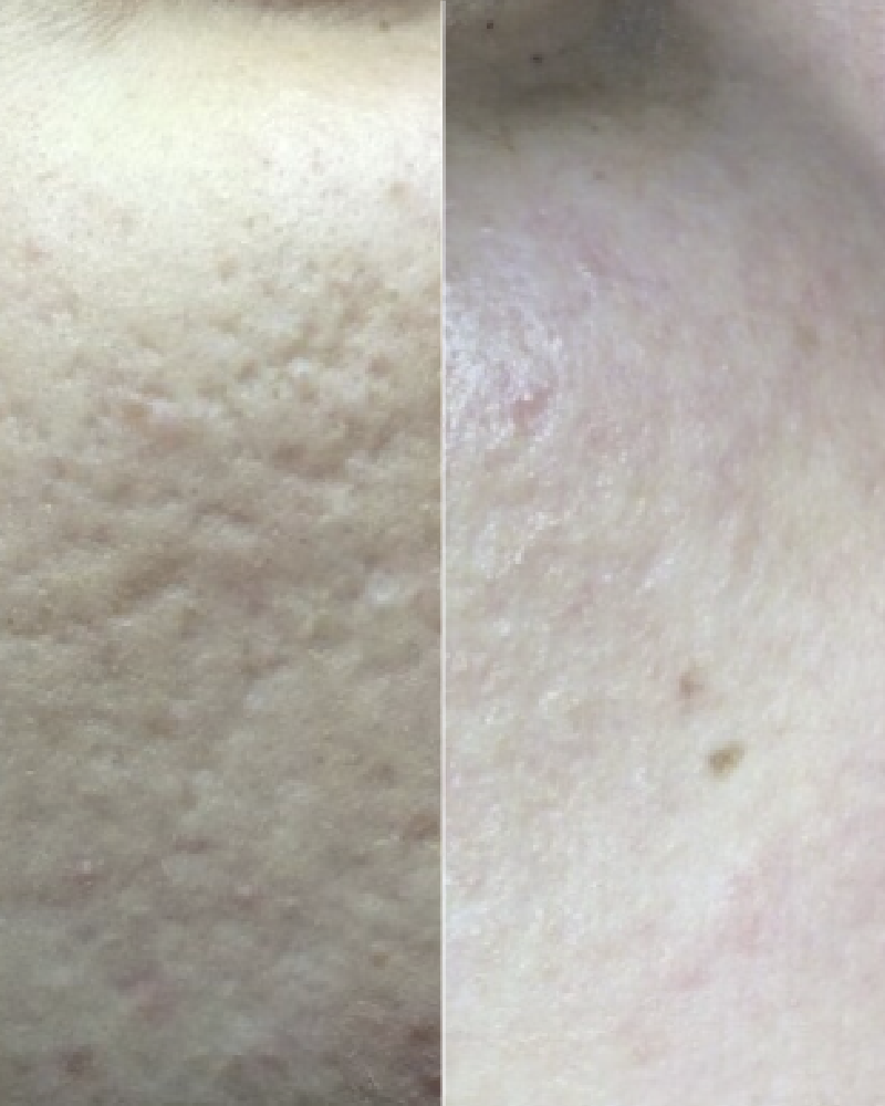 One (1) ResurFX Treatment - Full Face