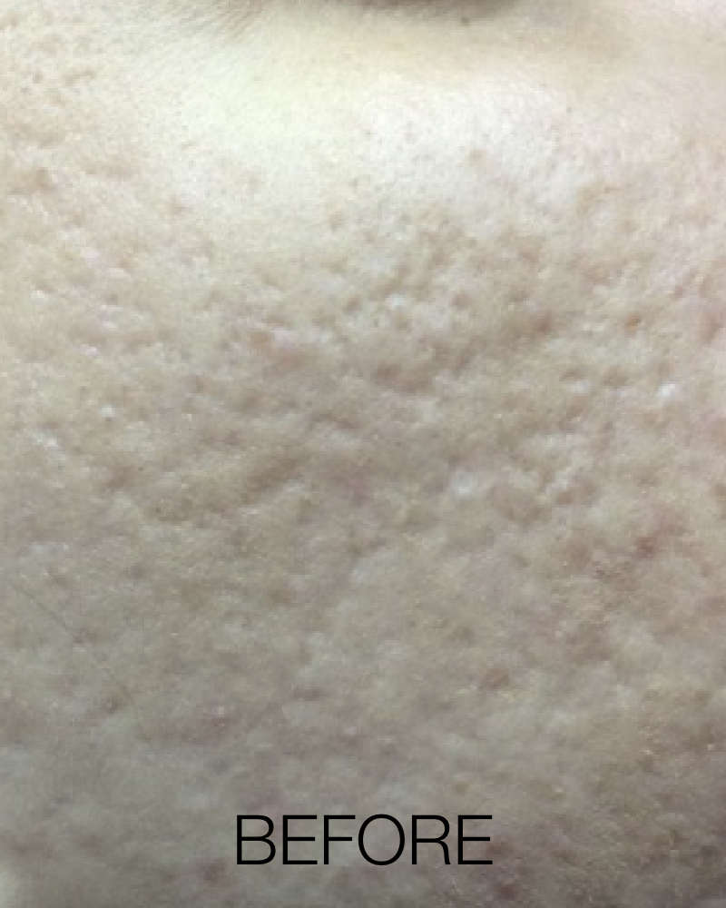 One (1) ResurFX Treatments (Full Face)