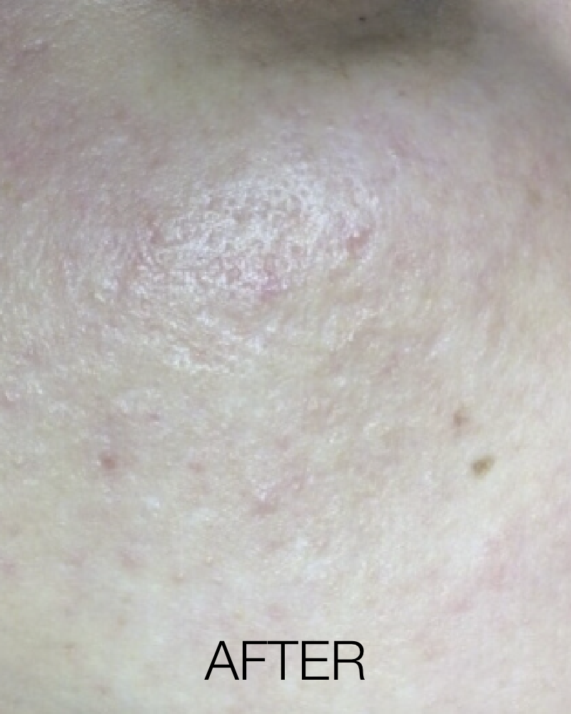 One (1) ResurFX Treatments (Full Face)